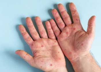 WHO Nyatakan Dunia Darurat Cacar Monyet