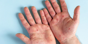 WHO Nyatakan Dunia Darurat Cacar Monyet